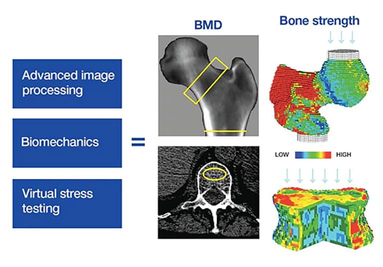 Beyond DXA: Multidimensional Assessment of Bone Strength and Fracture Risk